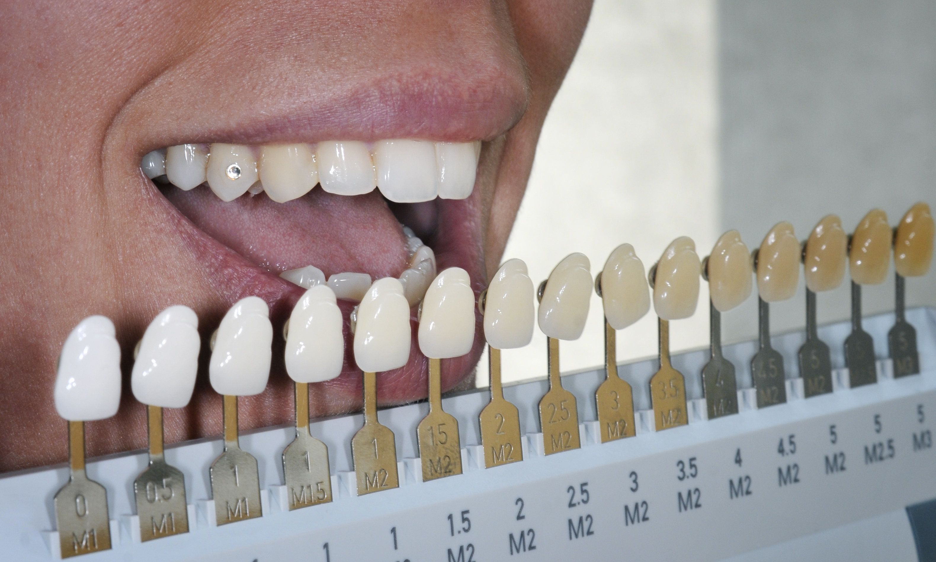 Dentist using a shade guide on a patient's teeth