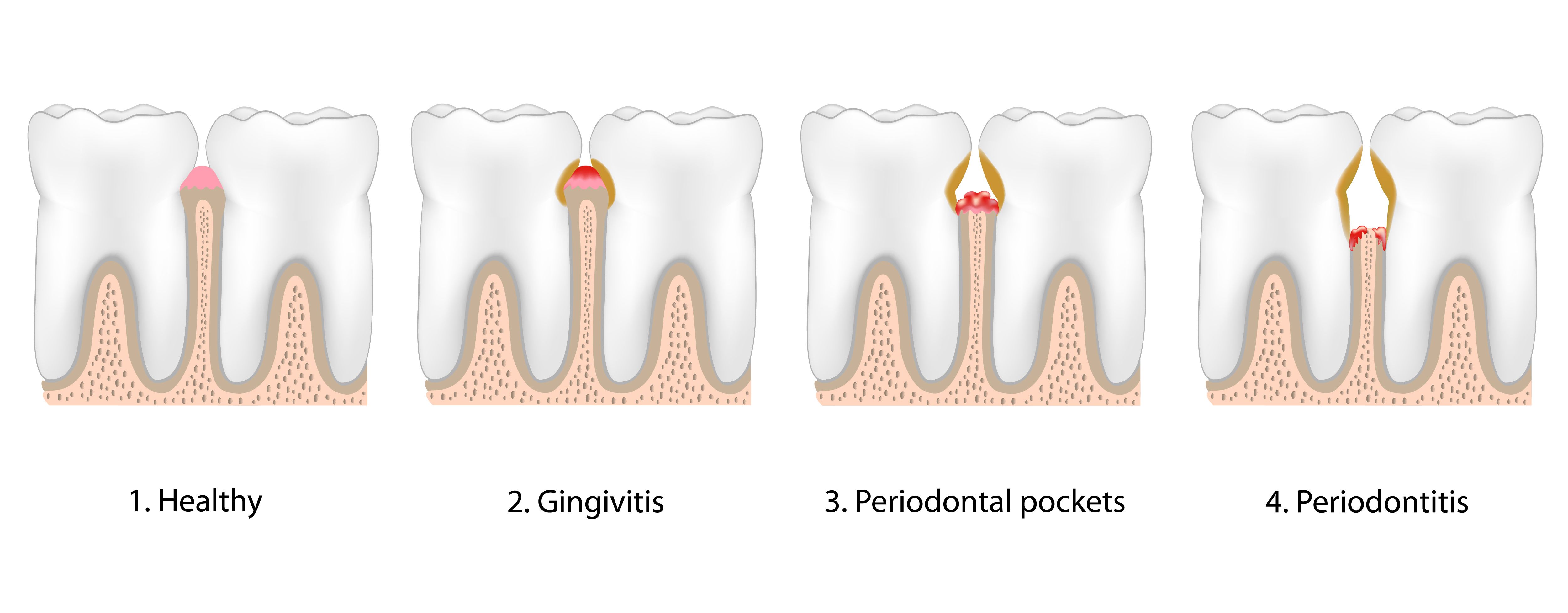 Infographic illustrating four stages of gum disease