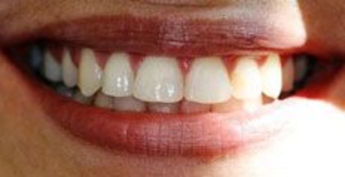 Case 2 after Invisalign